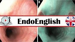 Heterotopic Gastric Mucosa in the Esophagus. МЕДИЦИНСКИЙ АНГЛИЙСКИЙ
